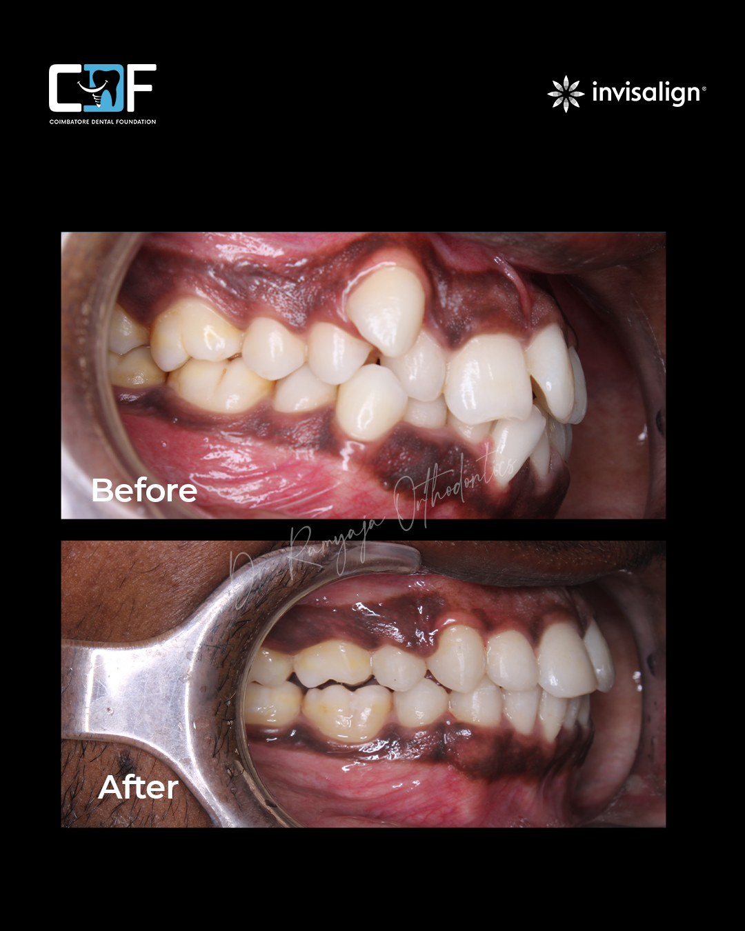 Before After Result